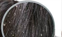 How to stop Dandruff in Winter?